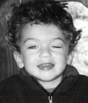 A person with congenital ptosis before surgery